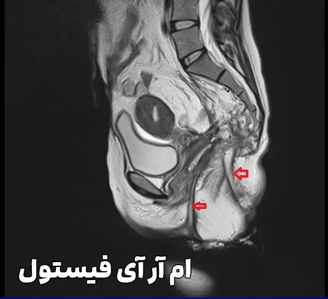 ام ار آی فیستول