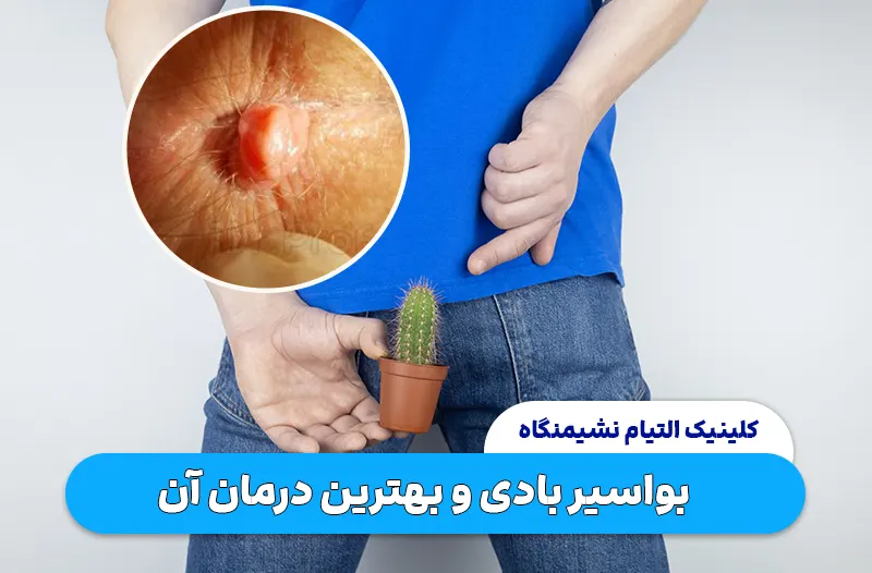 بواسیر بادی