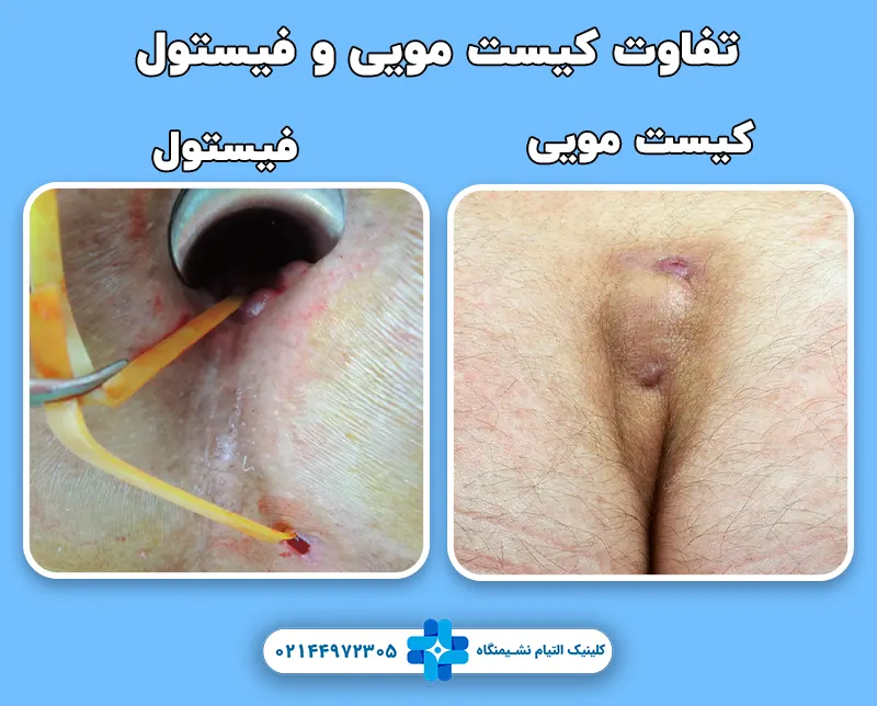 تفاوت کیست موی و فیستول