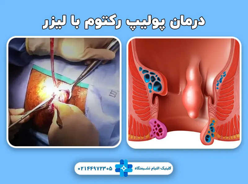 درمان پولیپ رکتوم با لیزر