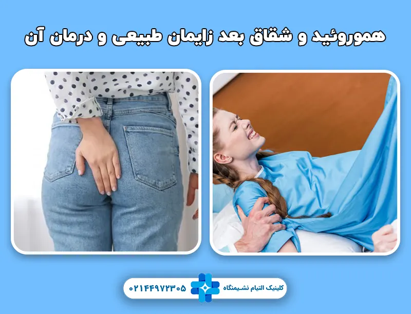 هموروئید و شقاق بعد زایمان طبیعی و درمان آن