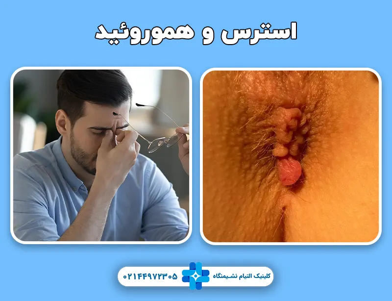 استرس و هموروئید