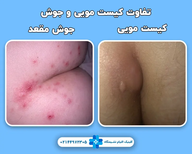 تفاوت کیست مویی و جوش