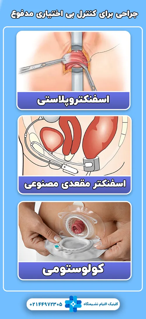 روش های جراحی برای کنترل بی ‌اختیاری مدفوع