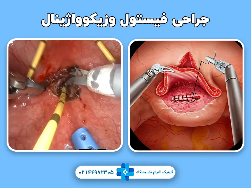 جراحی فیستول وزیکوواژینال