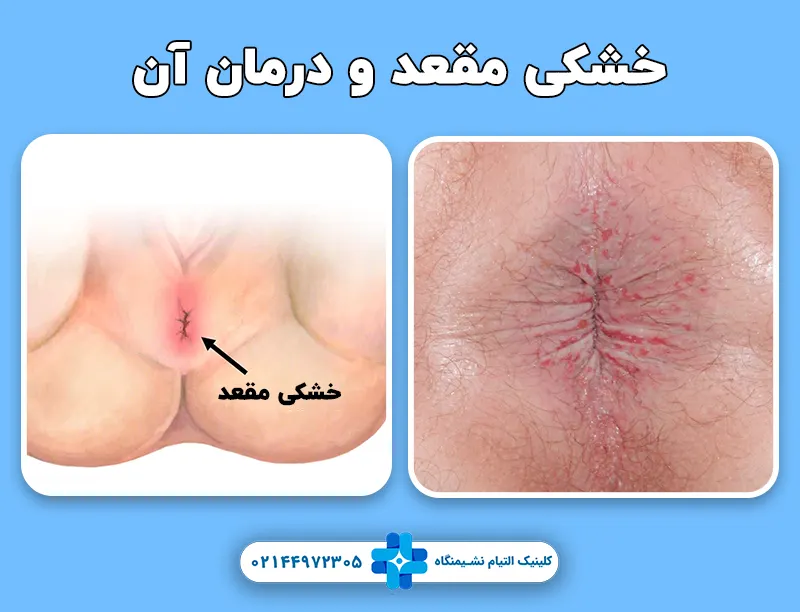 خشکی مقعد و درمان آن