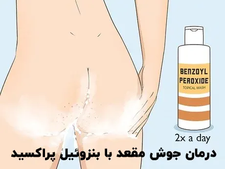 درمان جوش مقعد