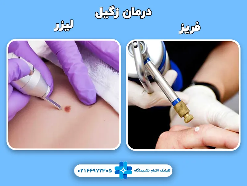 درمان زگیل