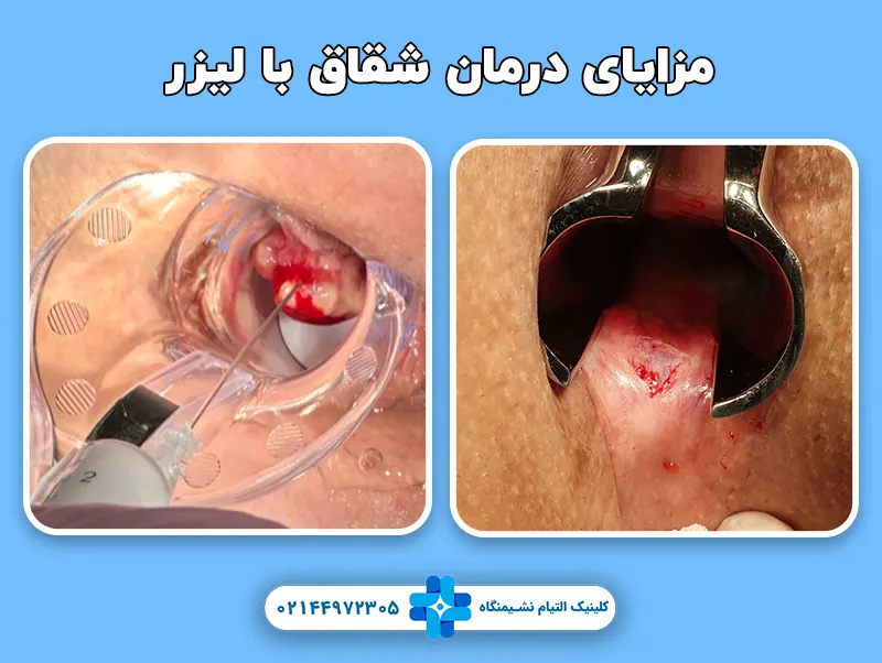 درمان شقاق با لیزر