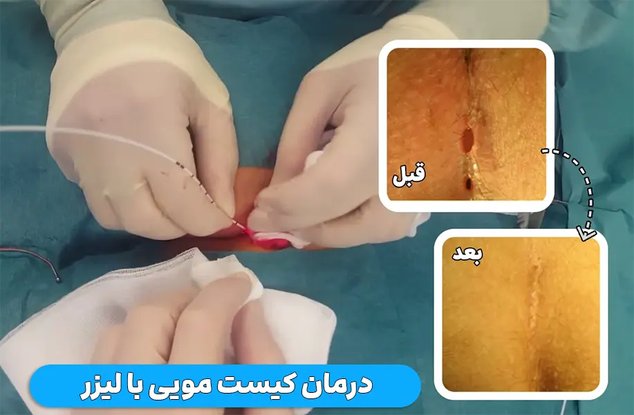 درمان کیست مویی با لیزر