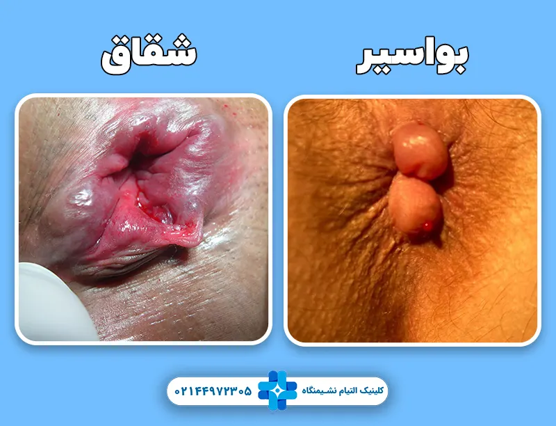 شقاق بواسیر