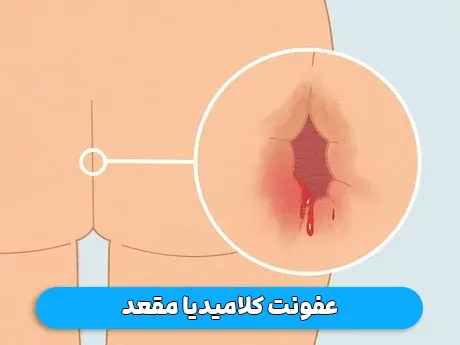 عفونت کلامیدیا مقعد