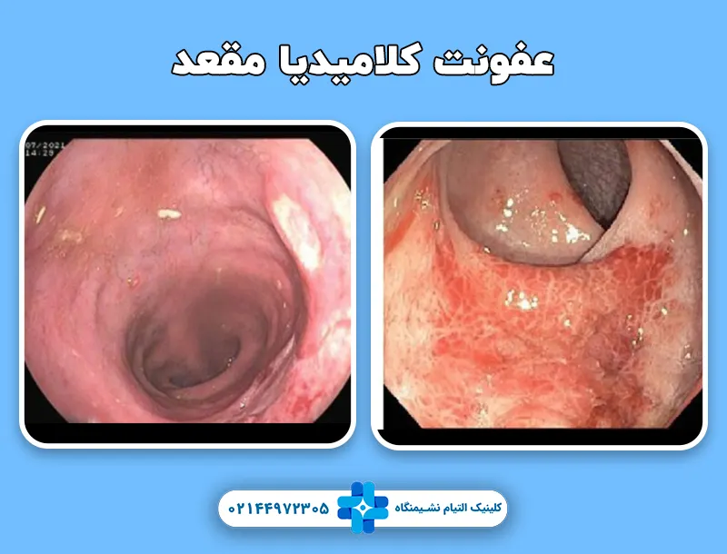 عفونت کلامیدیا مقعد