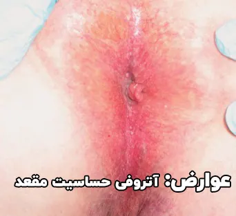 عوارض جانبی احتمالی پماد تریامسینولون