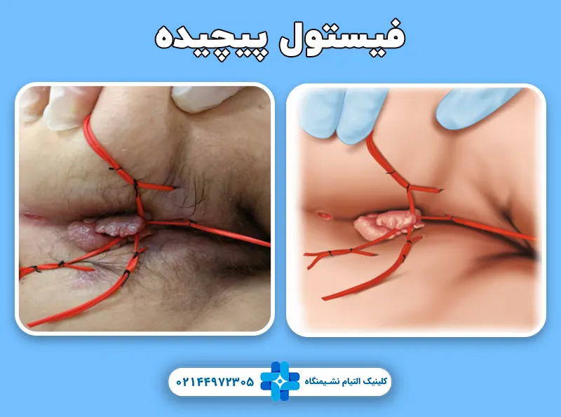 فیستول پیچیده