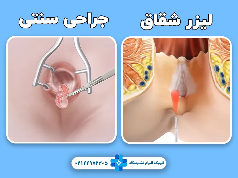 لیزر شقاق جراحی سنتی شقاق