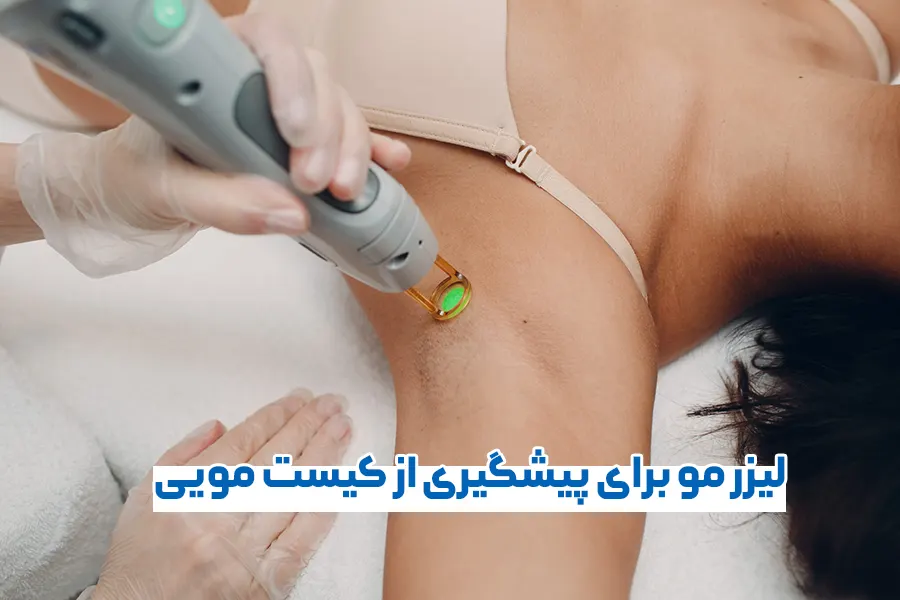 لیزر موهای زائد برای پیشگیری از کیست مویی