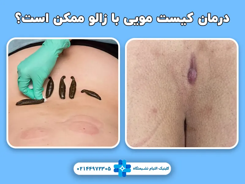 درمان کیست مویی با زالو