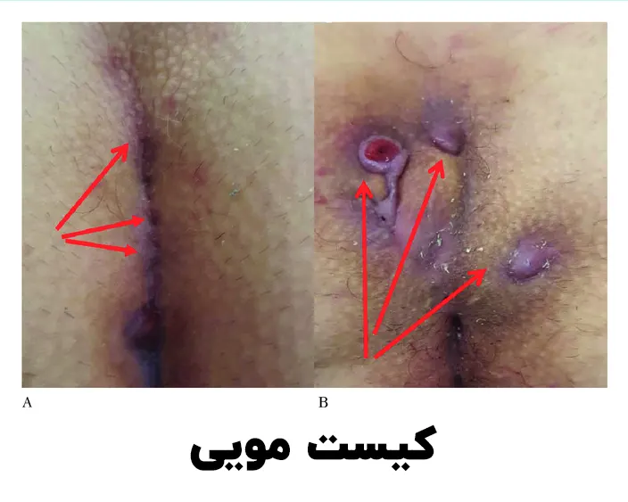 کیست مویی چیست