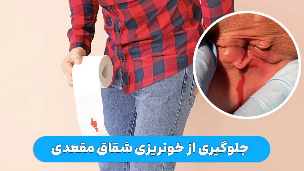 جلوگیری از خونریزی شقاق مقعدی