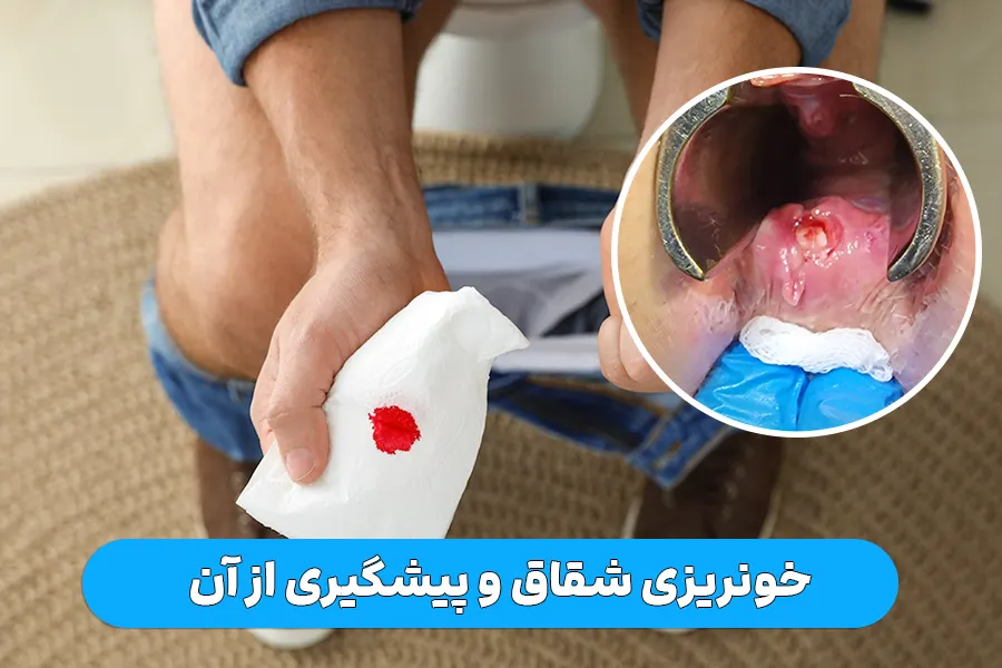 جلوگیری از خونریزی شقاق مقعدی
