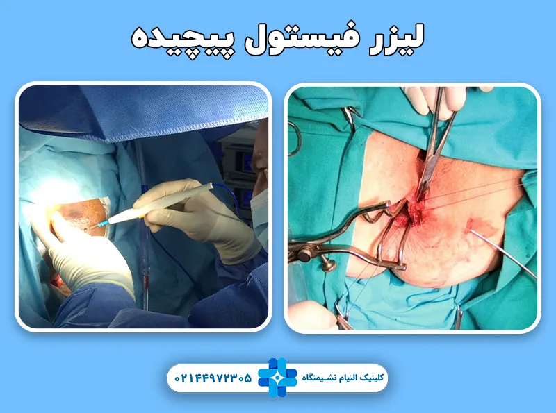 لیزر فیستول