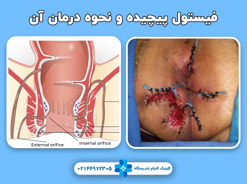 فیستول پیچیده