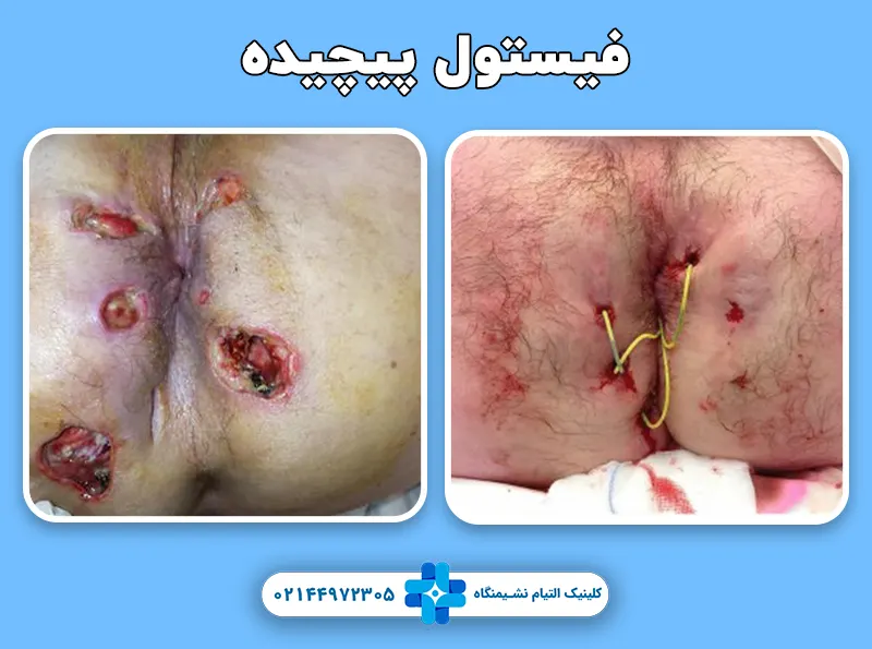 فیستول پیچیده