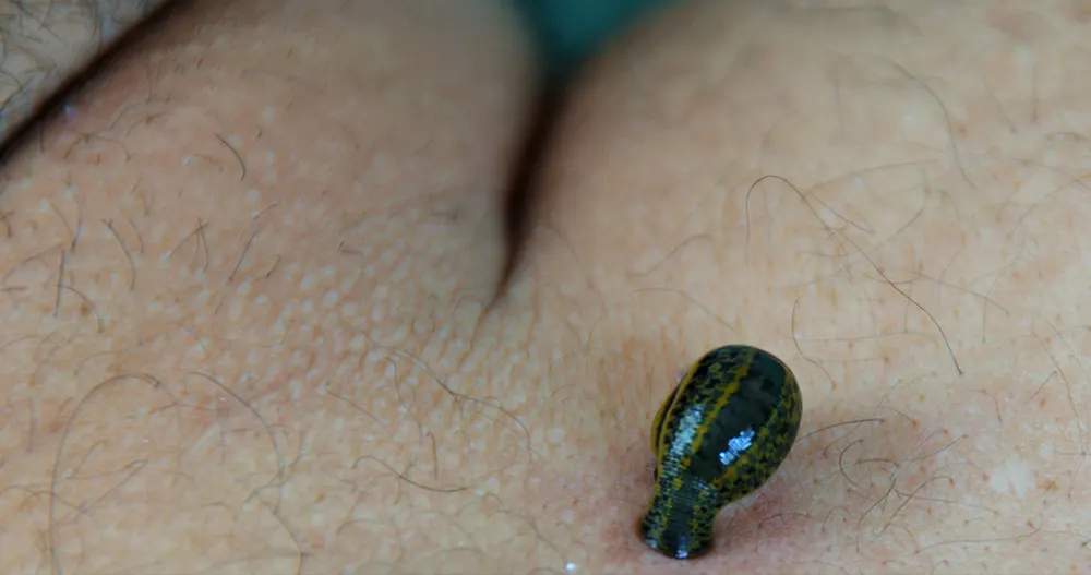 درمان کیست مویی با زالو