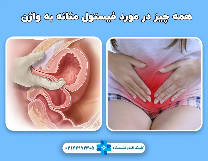 همه چیز در مورد فیستول مثانه به واژن