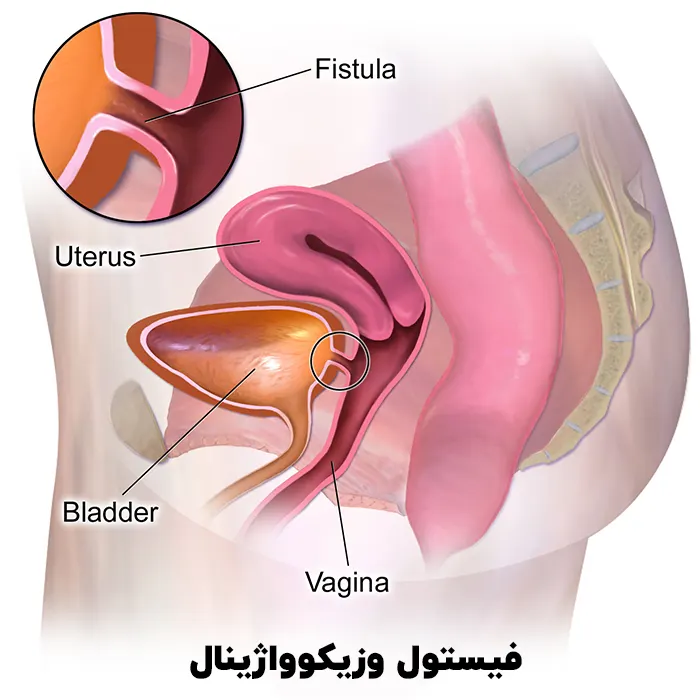 فیستول وزیکوواژینال