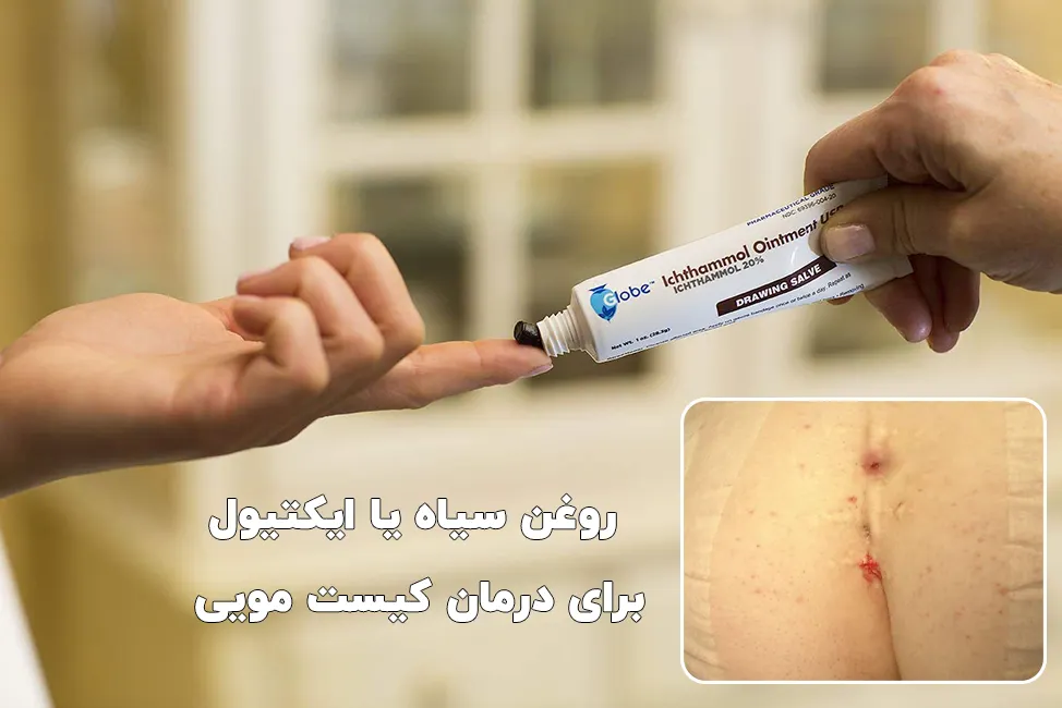 روغن سیاه یا ایکتیول برای درمان کیست مویی