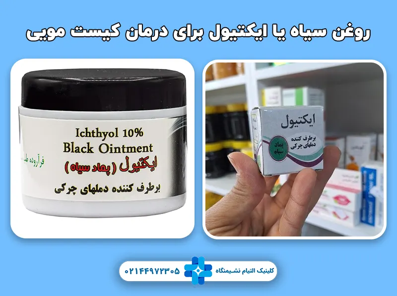 روغن سیاه یا ایکتیول برای درمان کیست مویی