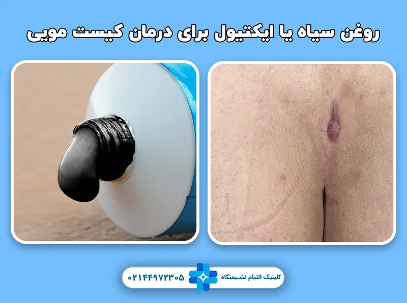 روغن سیاه یا ایکتیول برای درمان کیست مویی