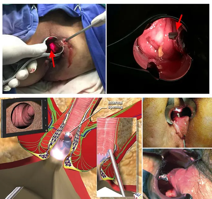 جراحی فیستول به روش vaaft