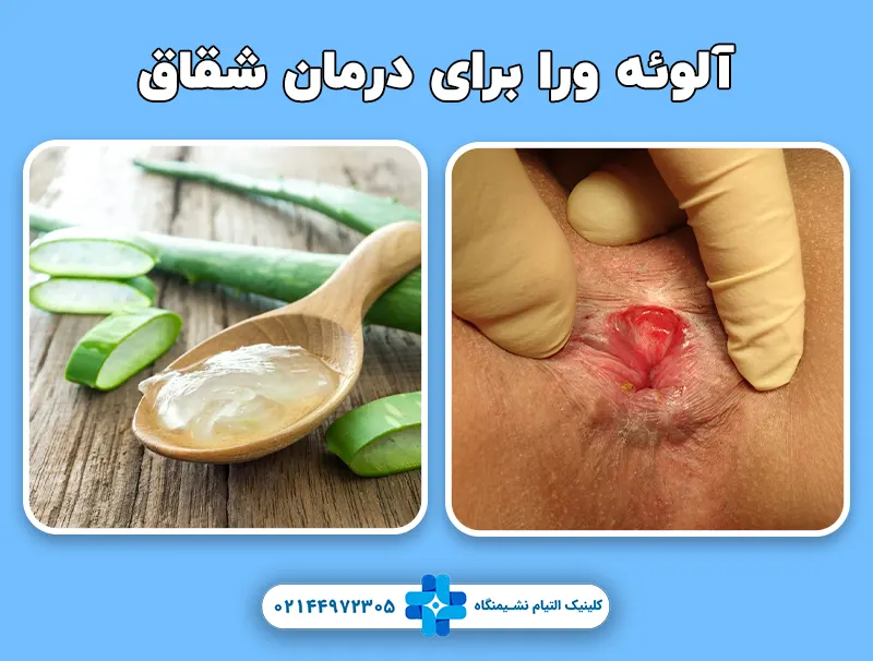 آلوئه ورا برای درمان شقاق