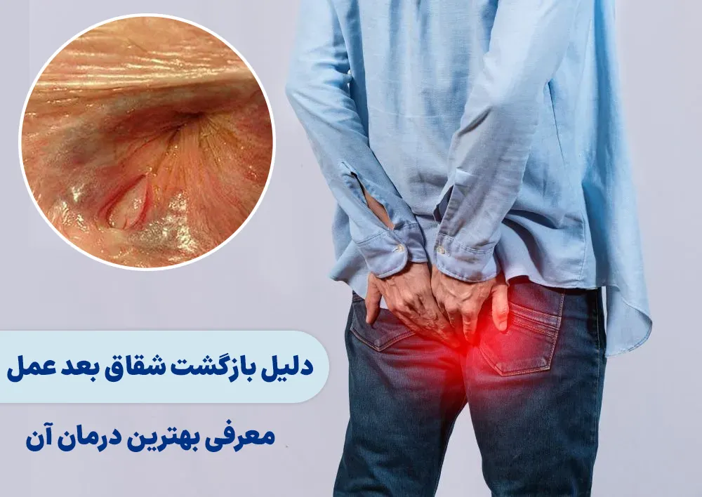 بازگشت شقاق بعد عمل