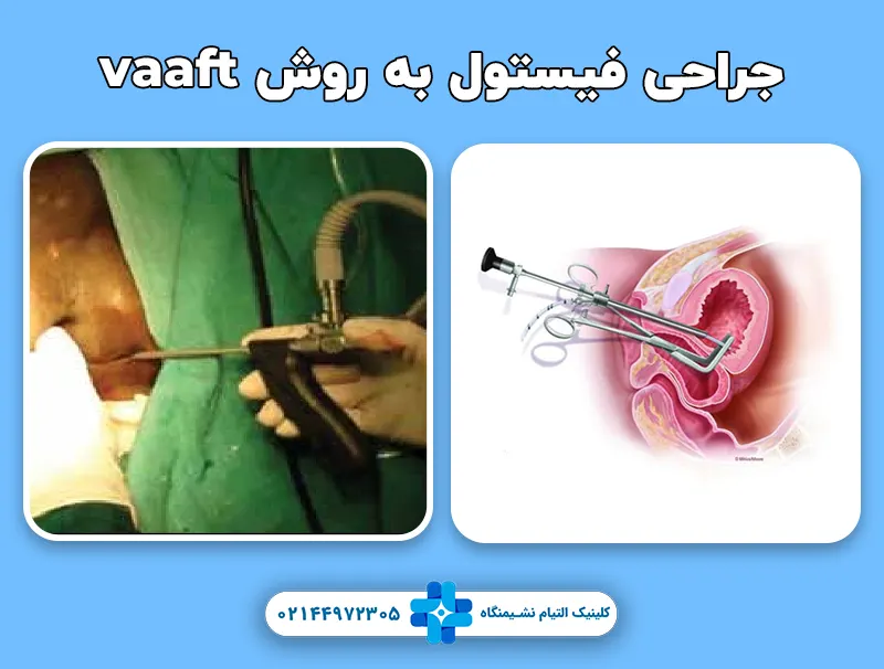 جراحی فیستول به روش vaaft