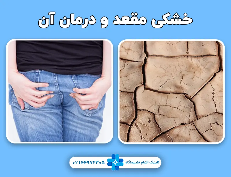 خشکی مقعد و درمان آن