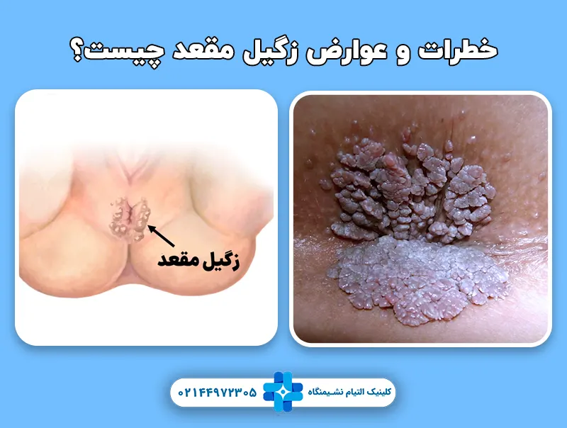 خطرات و عوارض زگیل مقعد