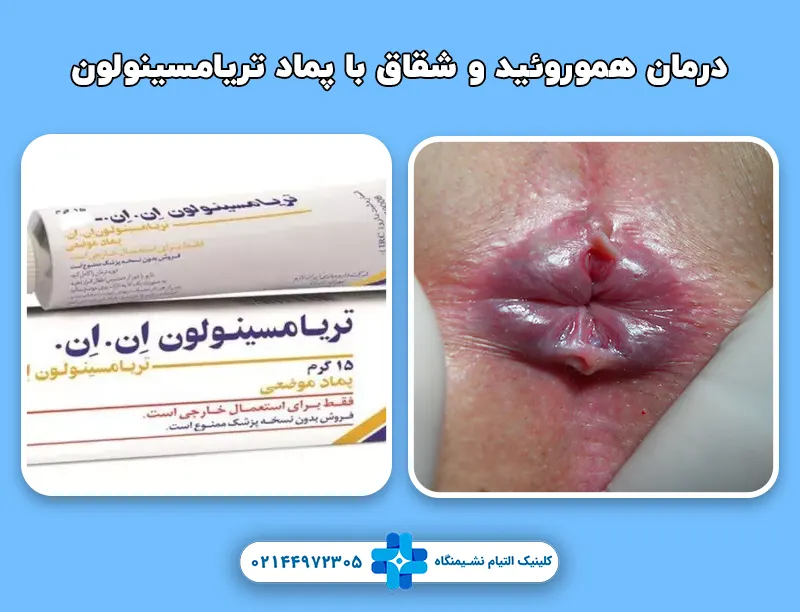 درمان هموروئید و شقاق با پماد تریامسینولون