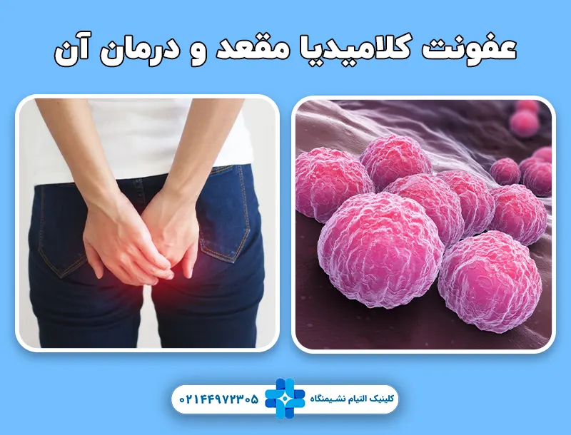 عفونت کلامیدیا مقعد و درمان آن