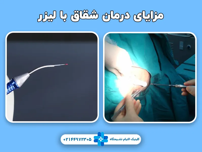 مزایای درمان شقاق با لیزر