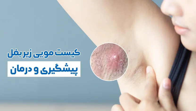 کیست مویی زیربغل