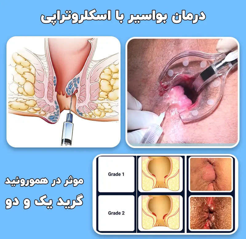روش درمان بواسیر با اسکلروتراپی