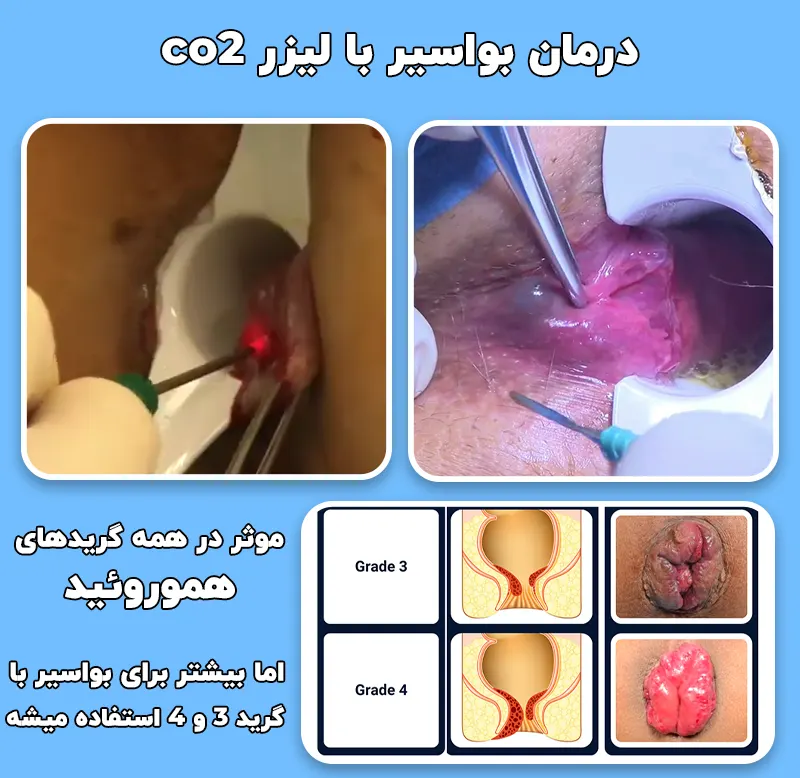 روش درمان بواسیر با لیزر CO2
