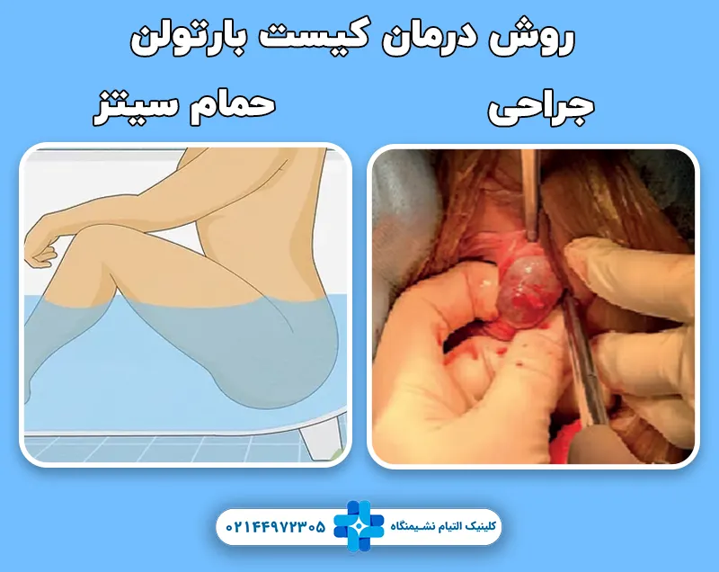 درمان کیست بارتولن