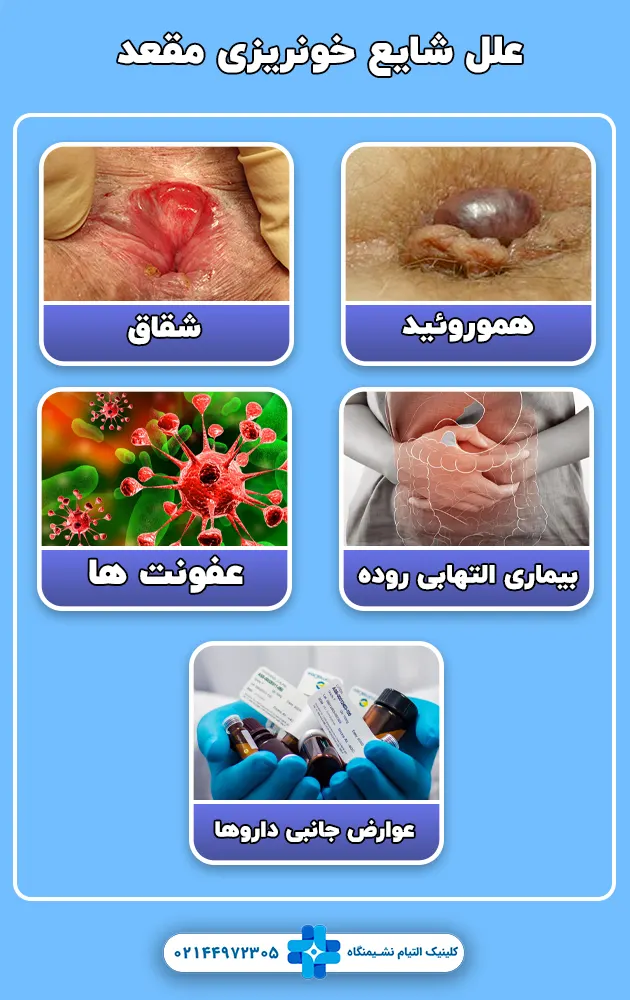 علل شایع خونریزی مقعد