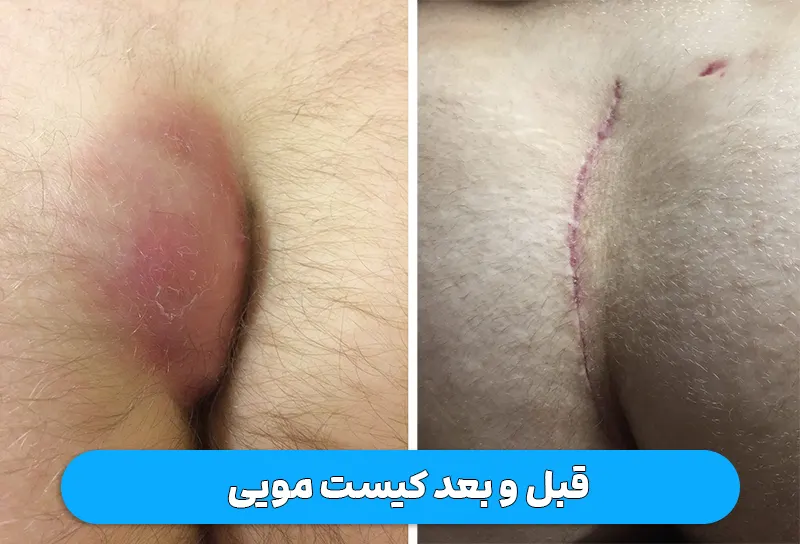 درمان کیست مویی