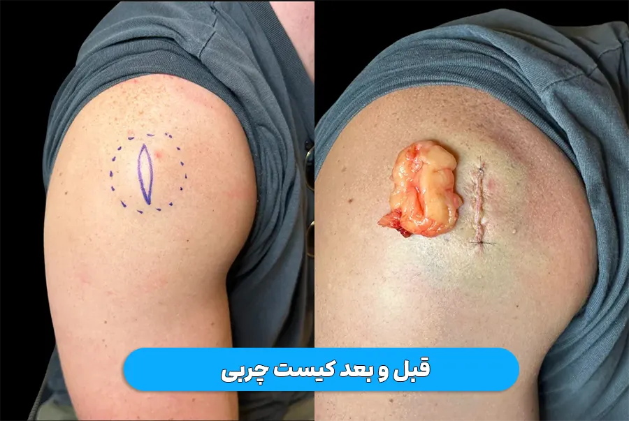 درمان کیست چربی